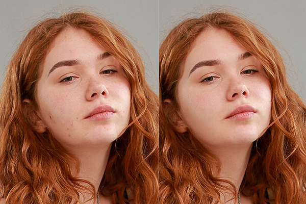 Pimple Acne Removal retouching