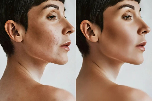 Scar Mark Removal Photo Editing